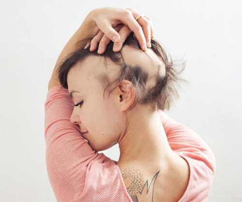 woman_alopecia.jpg
